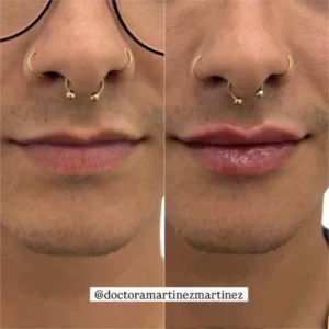 aumento-labios-masculino
