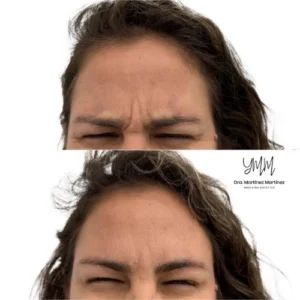 tratamiento-botox