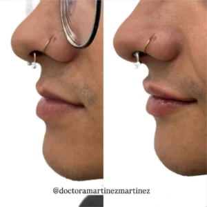 aumento-labios-perfil