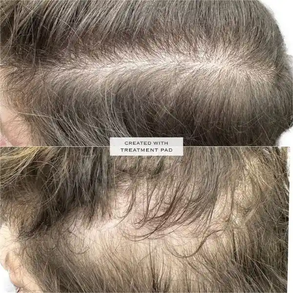 Mesoterapia-capilar2-nueva