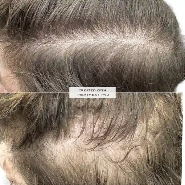 Mesoterapia-capilar1