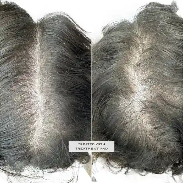 Mesoterapia-capilar2